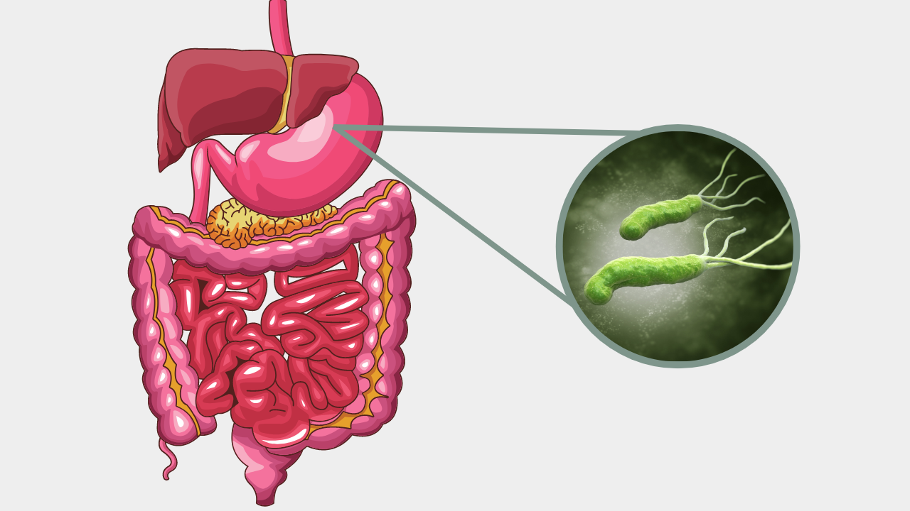 bariátrica com h. pylori
